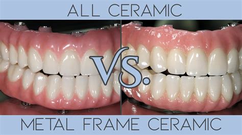 what is the metal housing denture|metal frame vs plastic dentures.